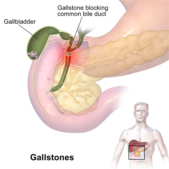 17 Day Diet Gallbladder Attack